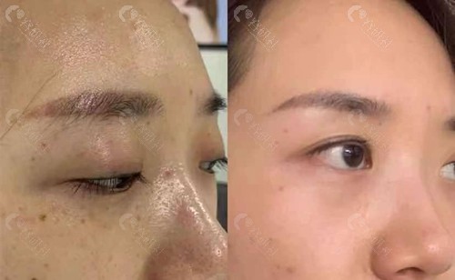杭州薇琳医疗美容医院超皮秒祛斑图片