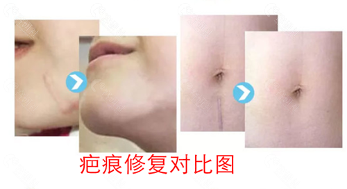 上海九院丁伟医生疤痕修复对比图