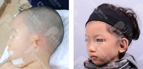韩国普罗菲耳小耳畸形矫正前后对比照片