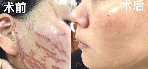 深圳鹏程医院面部祛疤效果对比图