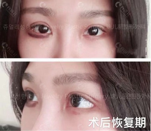 韩国珠儿丽双眼皮修复术后10天