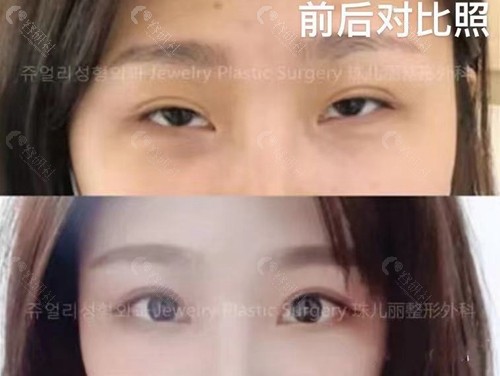韩国珠儿丽双眼皮修复术后两个月对比照