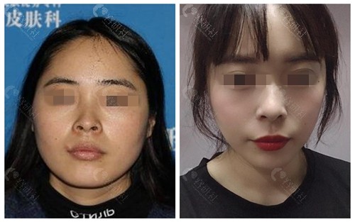 上海伊莱美下颌角手术前后对比照