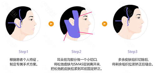 韩国珠儿丽拉皮手术方法
