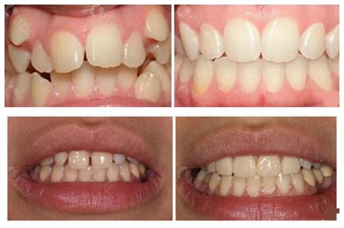 中山禾佳口腔牙齿矫正、牙齿美白前后对比照片