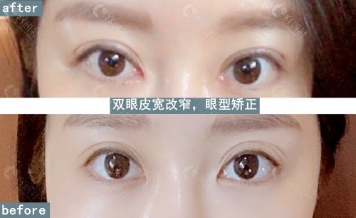 韩国大眼睛高汉雄双眼皮宽改窄+眼型矫正