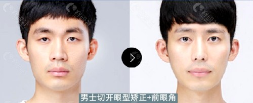 韩国大眼睛整形外科大眼睛男士切开眼型矫正+前眼角对比图