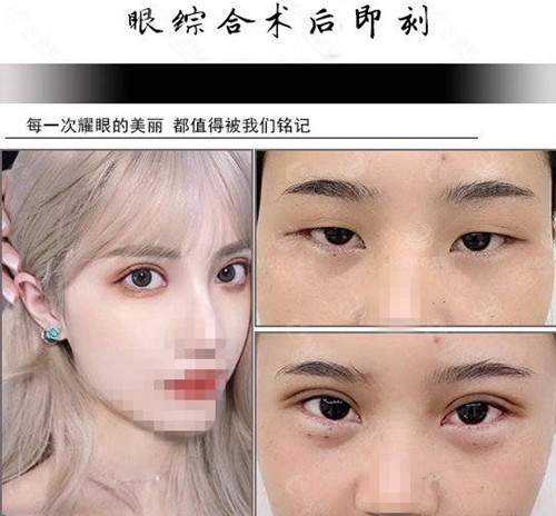 北京丽都医疗美容医院眼综合术后即刻对比效果图