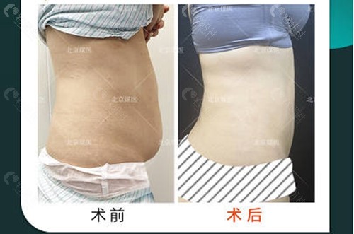 北京煤医西坝河整形医院腰腹吸脂术前术后对比图
