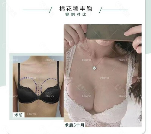 北京韩啸医疗美容医院棉花糖丰胸前后对比效果图展示