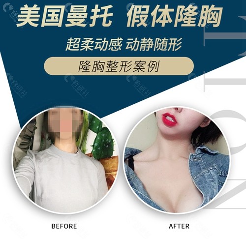 上海仁爱曼托假体隆胸前后对比