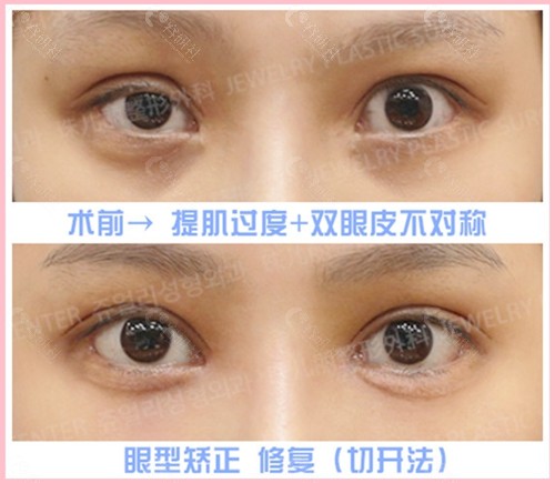 韩国珠儿丽提肌过度+双眼不对称修复图片