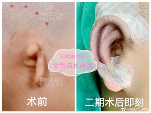 郭树忠教授全包法耳再造术前和二期术后即刻图片