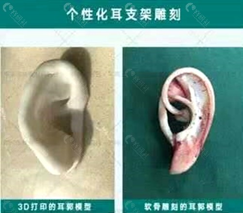 郭树忠教授个性化耳支架雕刻与健侧耳模型对比