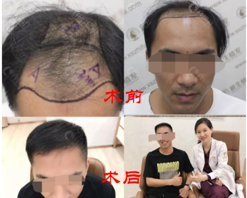 武汉新生男士植发术前术后对比图展示