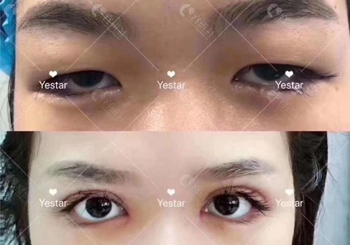 杭州艺星杨连华割双眼皮前后对比照片
