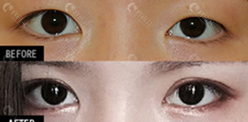 韩国爱护医院双眼皮对比图