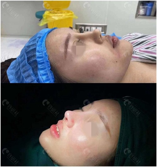 深圳福华医疗美容鼻修复前后对比