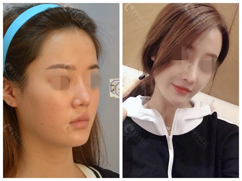 深圳阳光医疗美容鼻修复前后对比