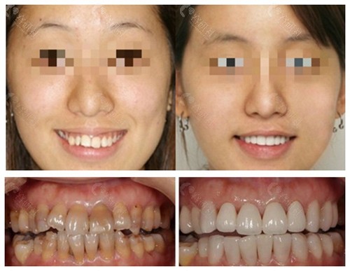 邵阳雅贝康口腔牙齿美白和牙齿矫正前后对比照片