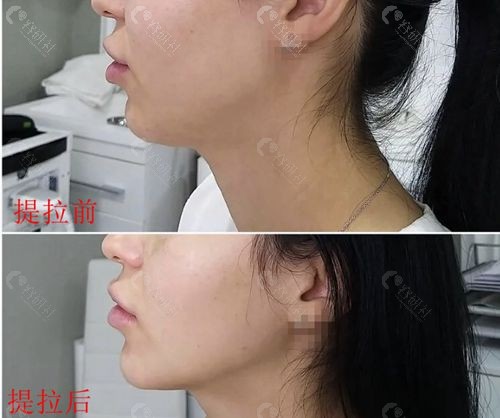 韩国7d聚拉提提升下颌缘前后对比效果图