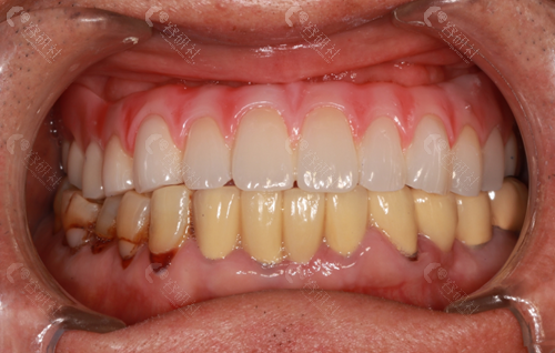 包头植诺口腔半口种植牙对比照片