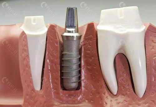 种植牙嵌入过程