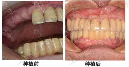 北京圣贝多颗牙缺失种植前后对比照