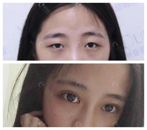 赣州亚韩割双眼皮术前术后对比照片