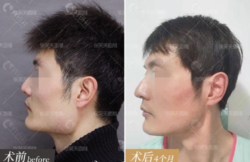 北京张笑天下颌角截骨手术前后效果
