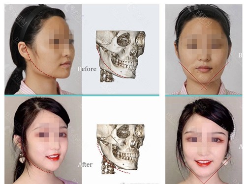上海愉悦美联臣医疗美容医院下颌角手术对比效果图分享