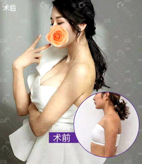 重庆美莱整形美容医院丰胸对比照