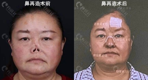 西安国 际医学师俊莉鼻部再造手术照片