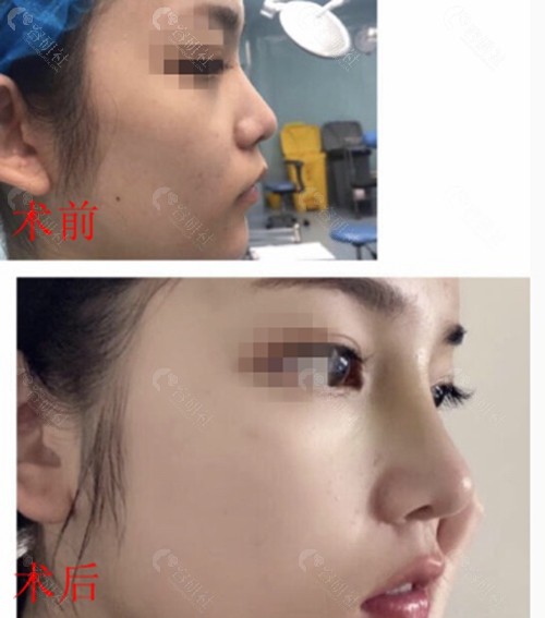塌鼻隆鼻改善术前术后对比图展示