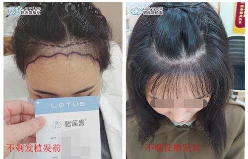 北京碧莲盛不剃发发际线种植术前术后对比图