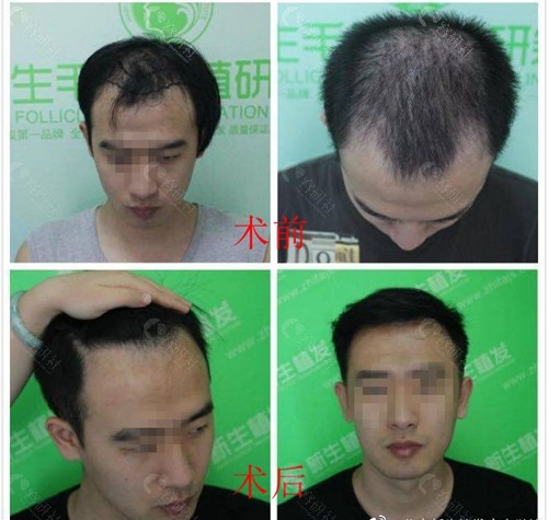 北京新生头顶加密植发术前术后对比图
