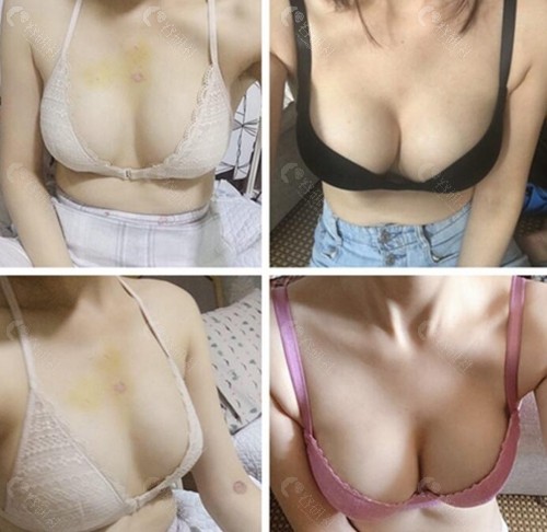 韩国普罗菲耳郑在皓假体隆胸术前术后效果图