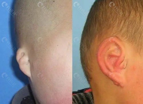 耳再造手术前后效果对比