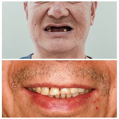北京海德堡联合口腔医院种植牙前后效果对比