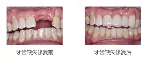 北京中诺口腔种植牙真人病例