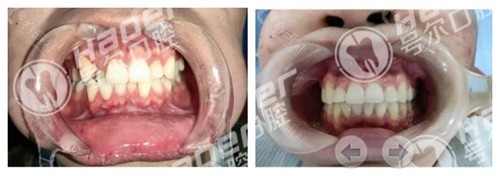 襄阳号尔口腔牙齿矫正前后对比图