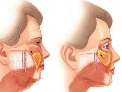 做面部拉皮手术能维持几年？