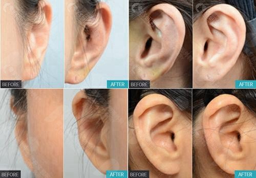 多组耳畸形矫正前后变化图片