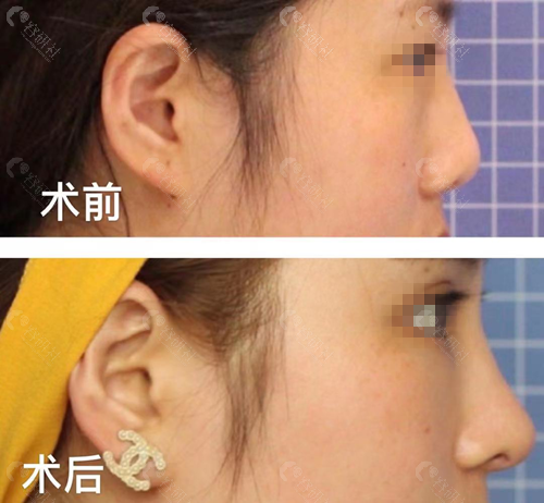 上海薇琳医疗美容医院隆鼻前后效果图