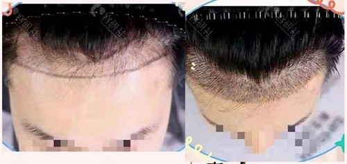 深圳新生种植发际线前后对比照片