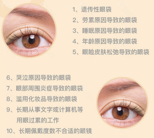 眼袋的十种类型