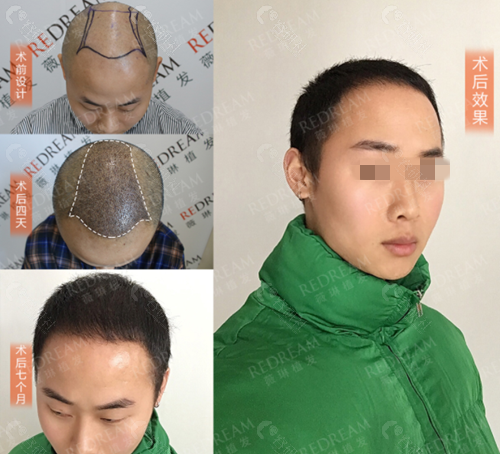 杭州薇琳植发男士头顶加密种植前后对比照