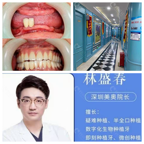 深圳美奥口腔医院种植牙对比照
