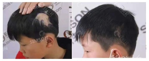 广州新生疤痕植发前后对比