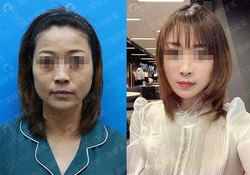 北京加减美面部提升手术前后效果对比